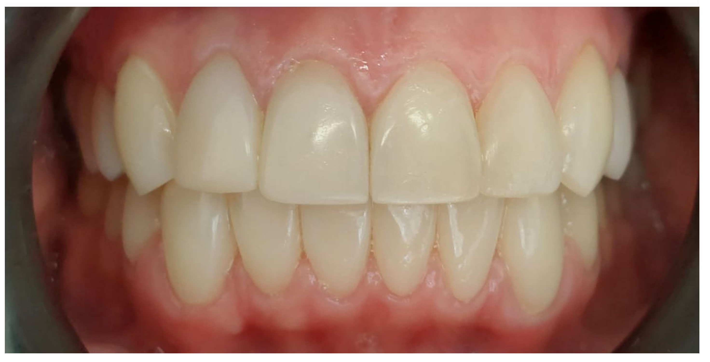 Композитные виниры