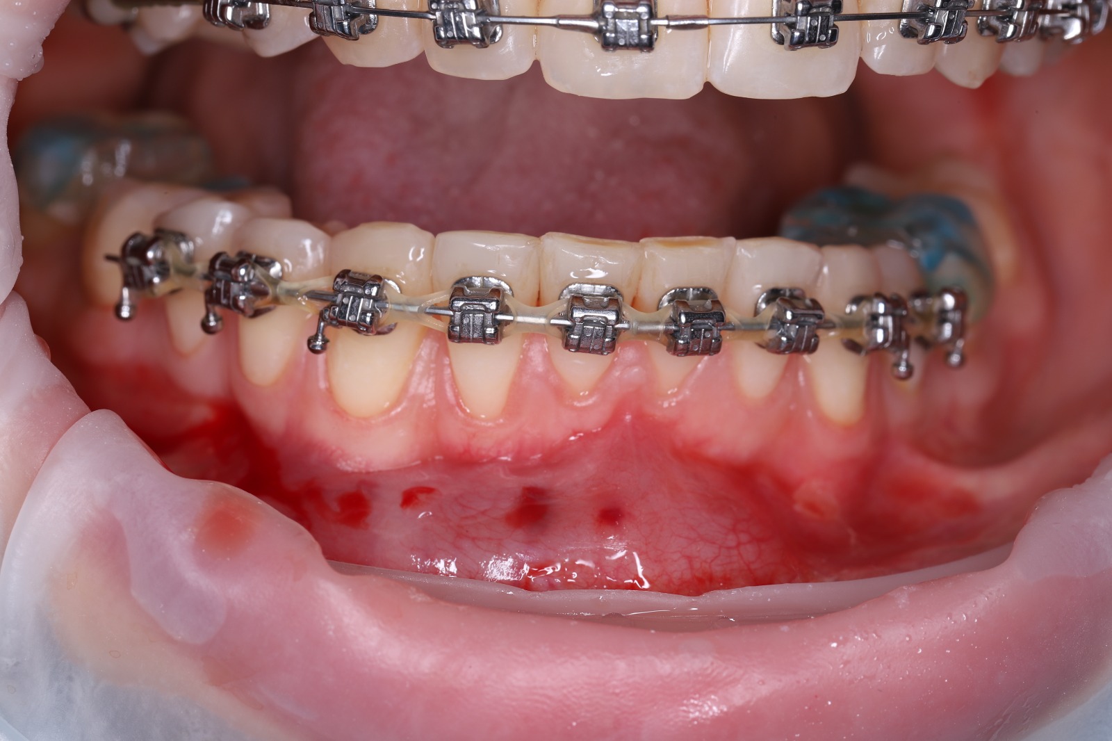 Закрытие рецессий