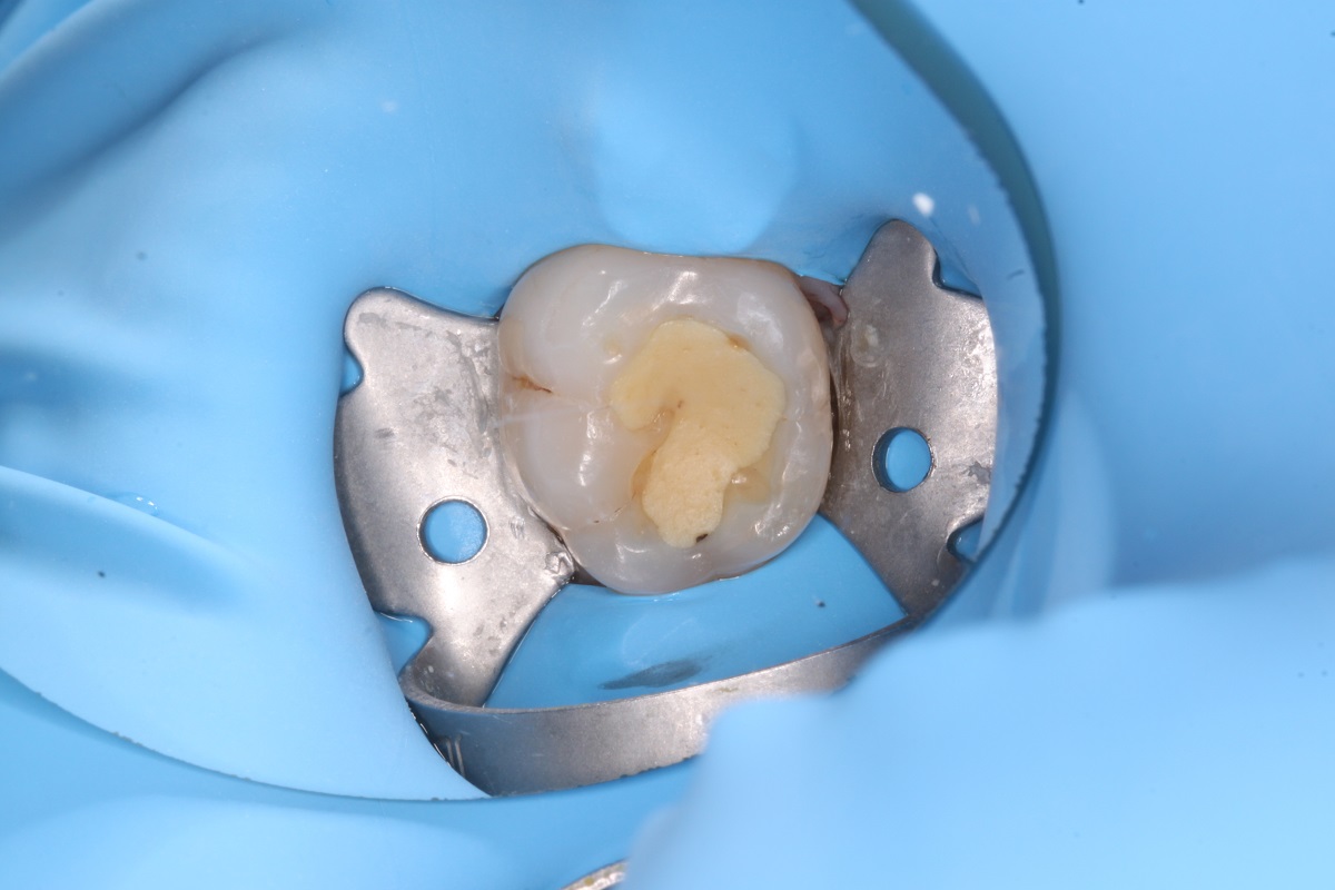 Лечение кариеса