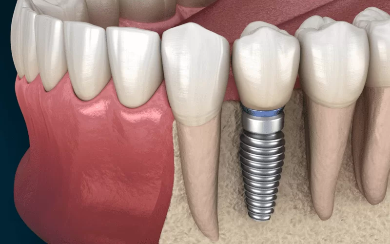 Чем отличается протезирование от имплантации зубов