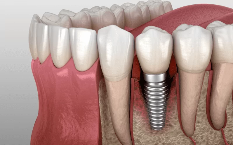 Есть ли вред от зубных имплантов
