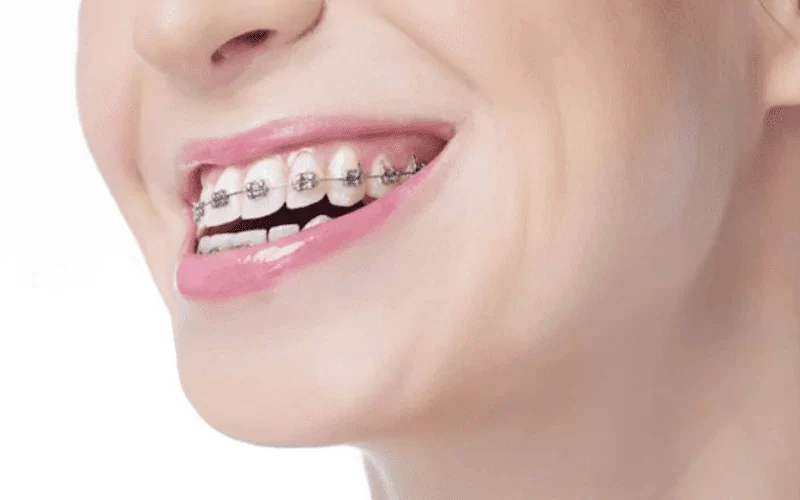 Мезиальный прикус: причины развития, виды, методы коррекции