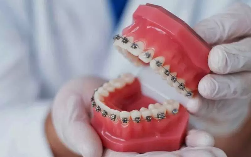 Больно ли ставить, носить и снимать брекеты