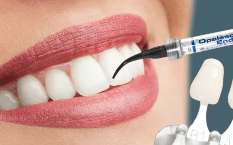 Какие виды отбеливания лучше и безопаснее?