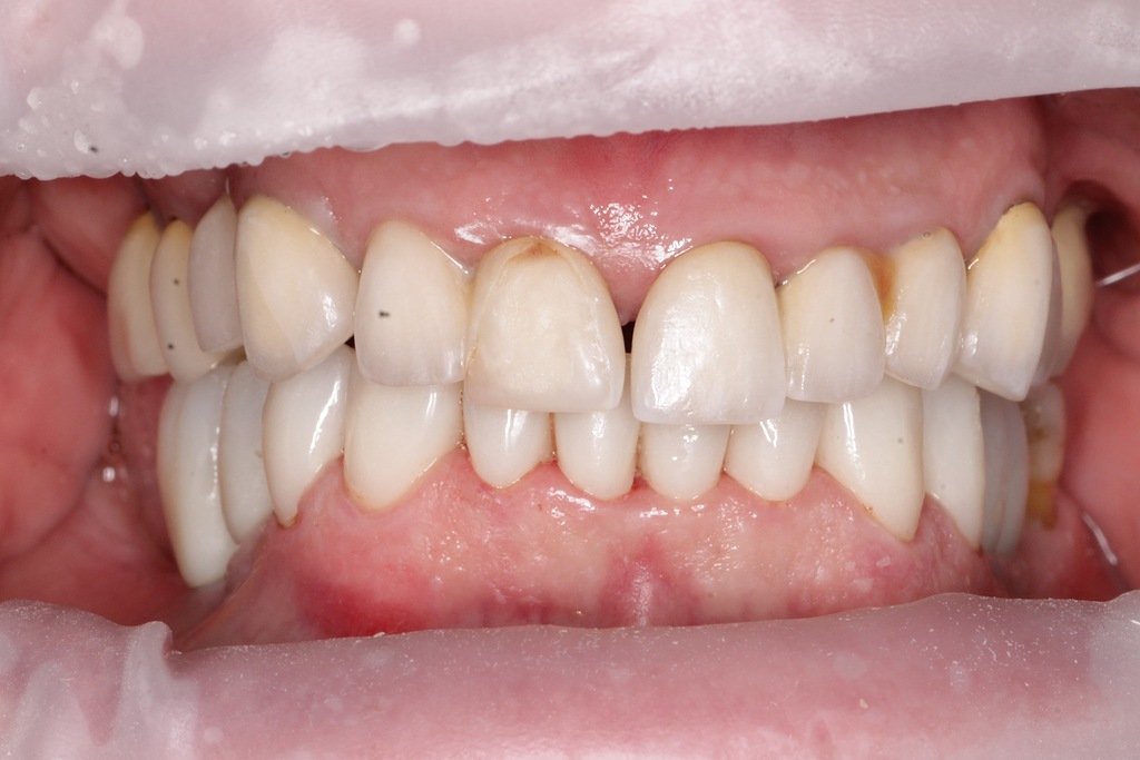 Циркониевые коронки