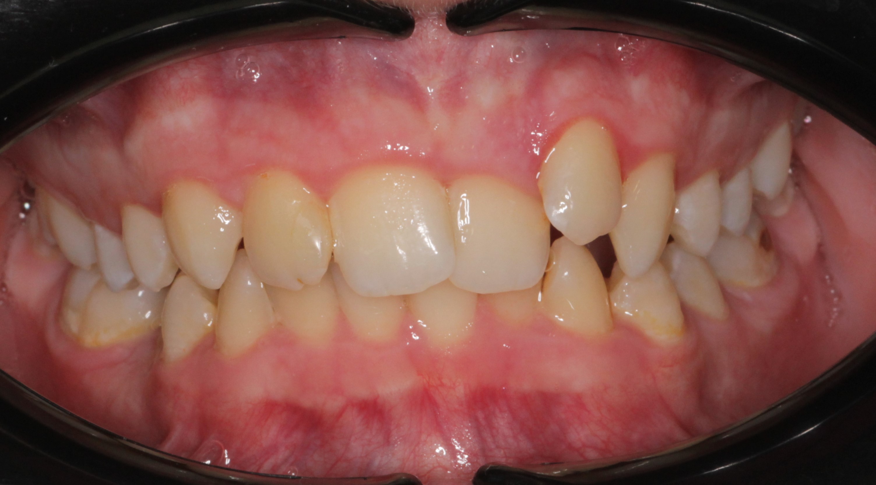 Исправление прикуса брекетами