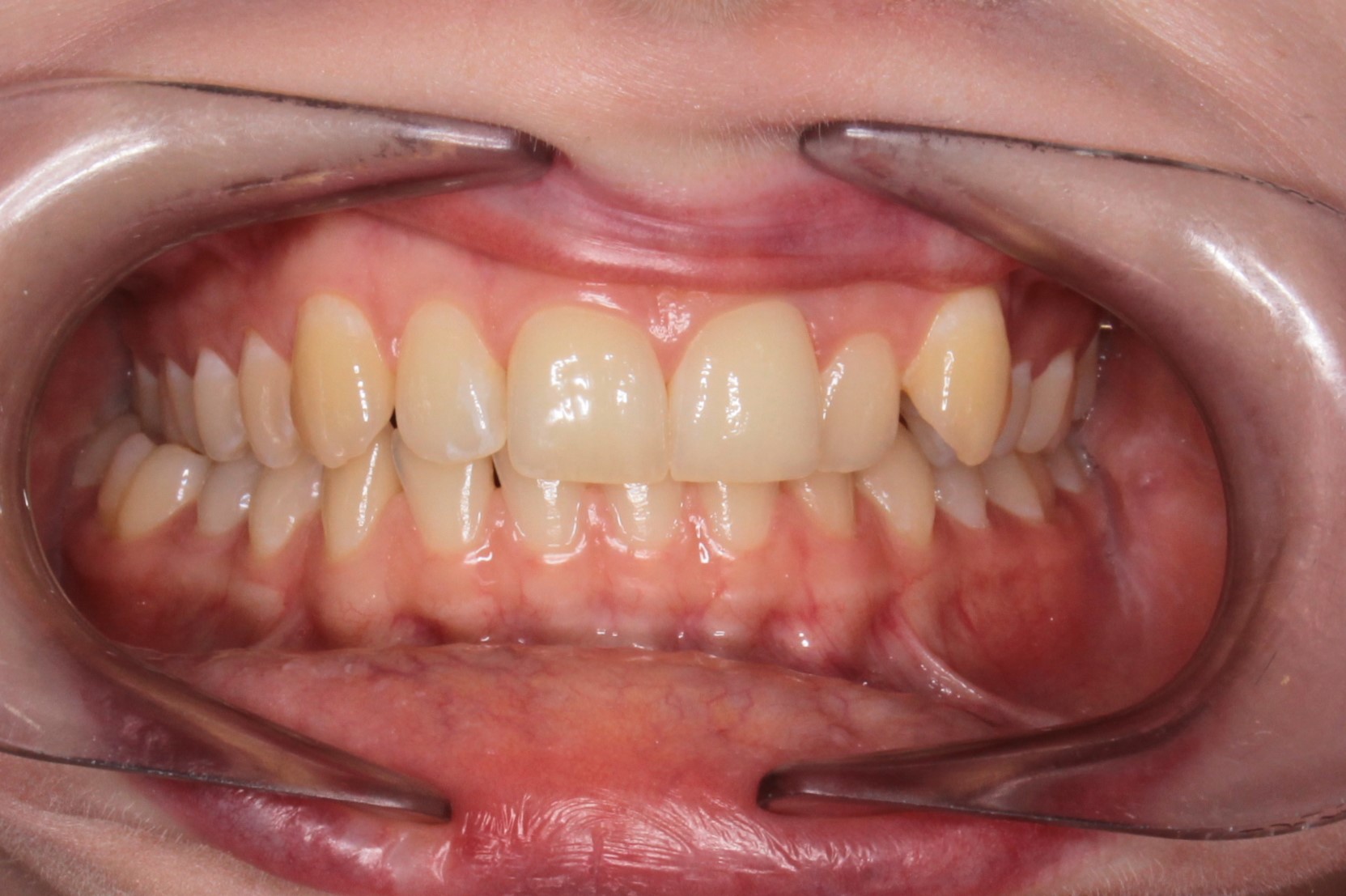 Исправление прикуса брекетами