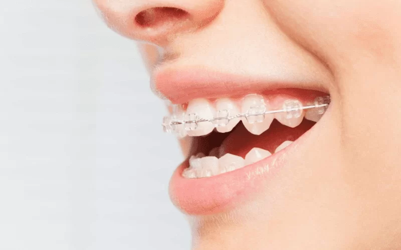 Как исправить дистальный прикус