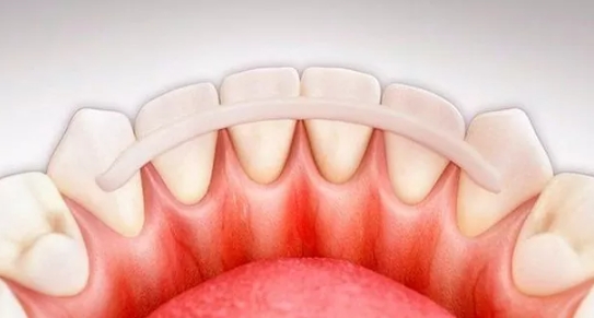 Шинирование зубов