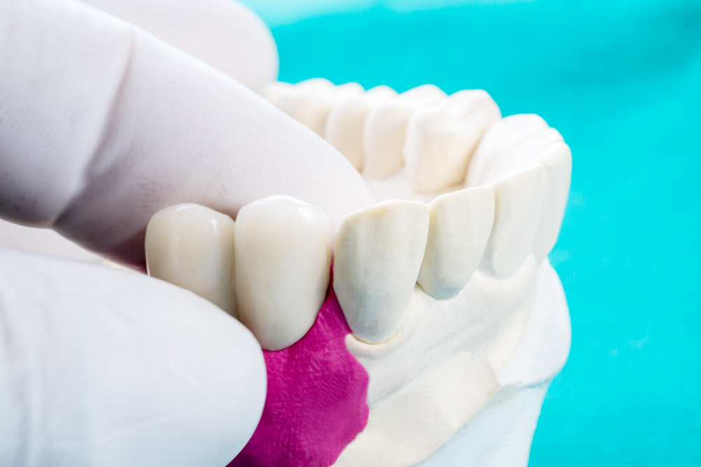 Нужна ли обточка зубов при протезировании?