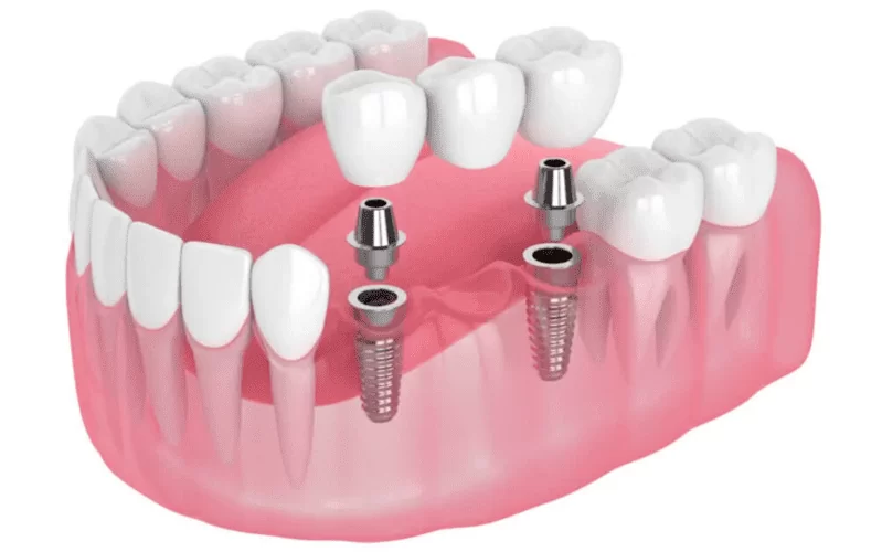 Мост или имплант - что лучше?