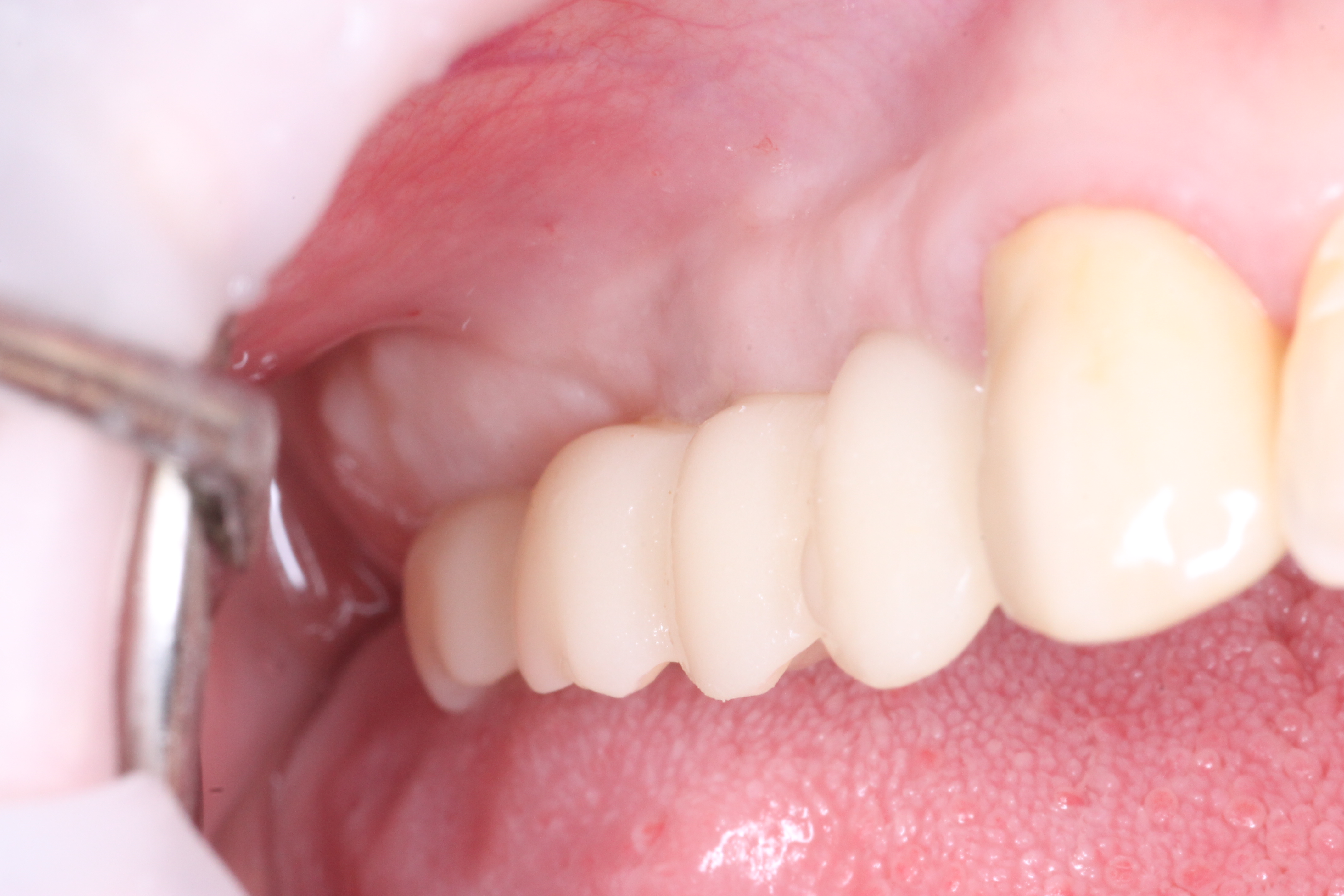 Десневая пластика в области имплантатов