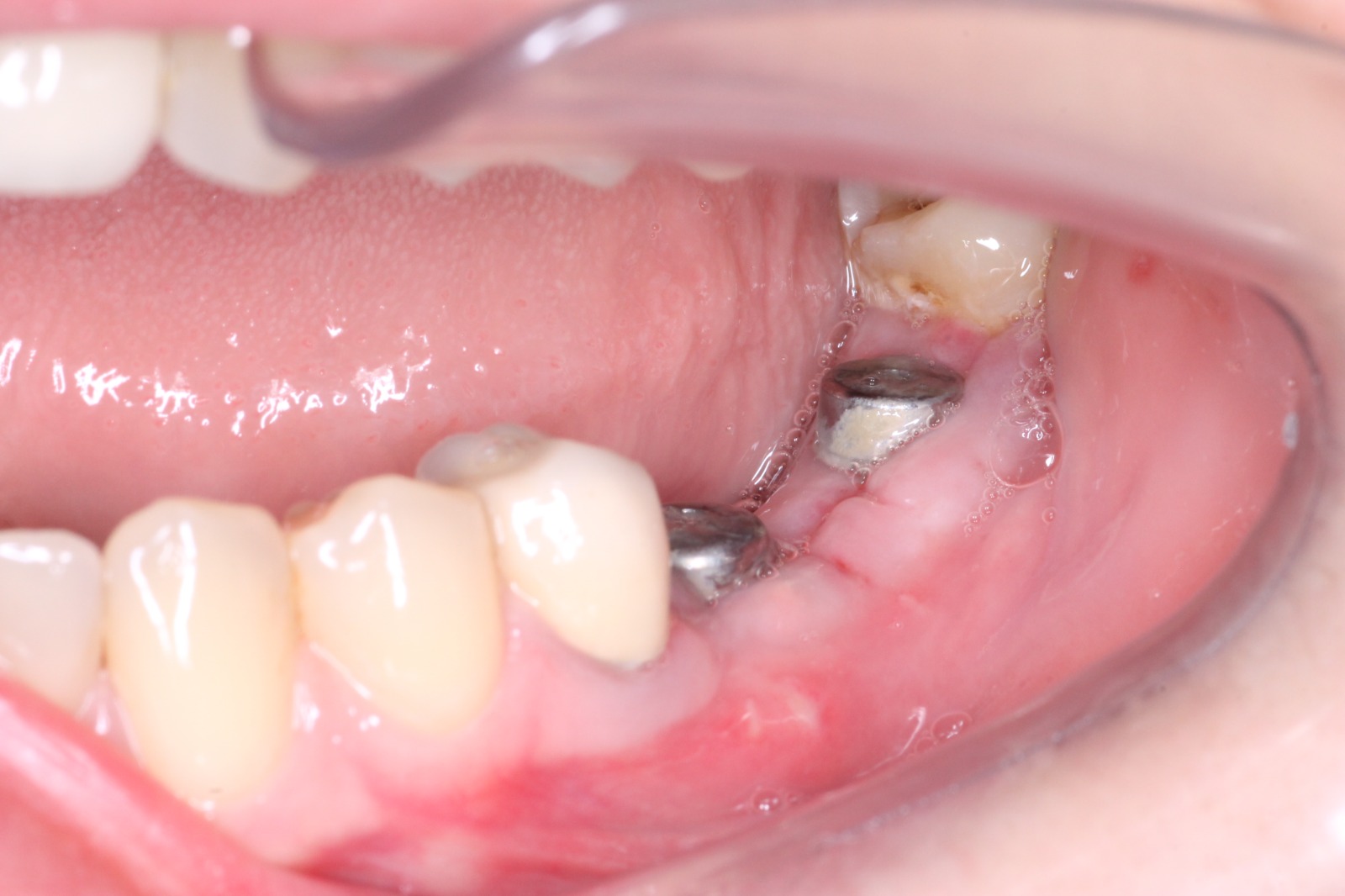 Десневая пластика в области имплантатов
