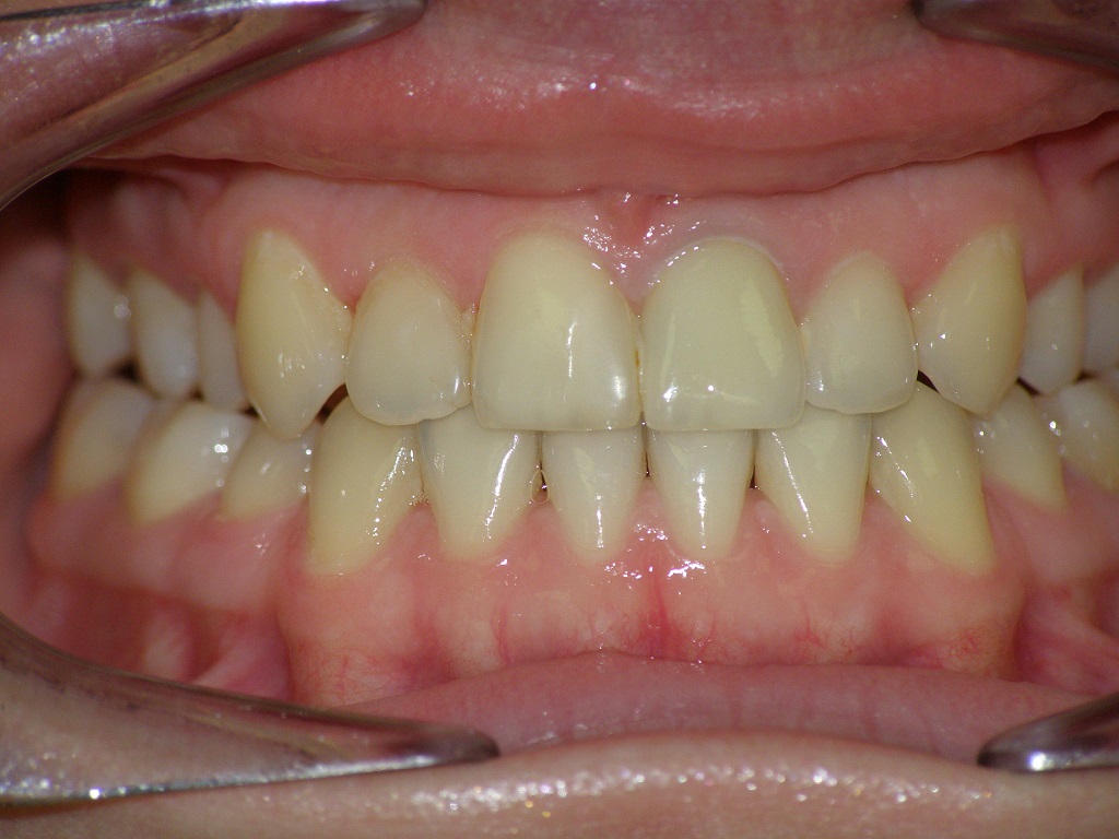 Исправление прикуса