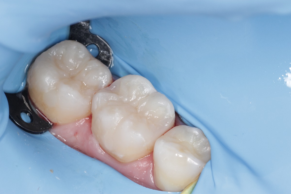 Лечение кариеса