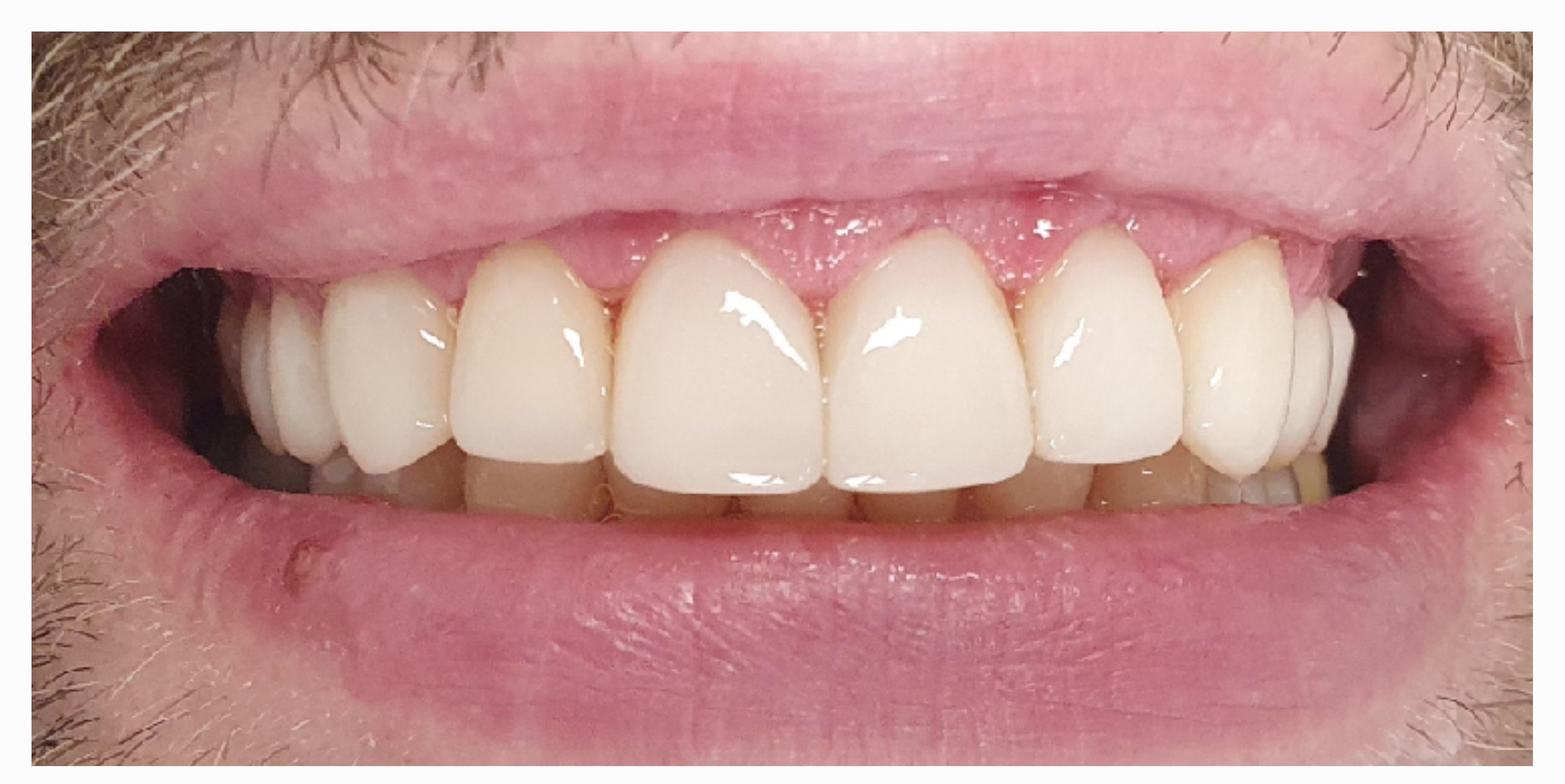 Композитные виниры