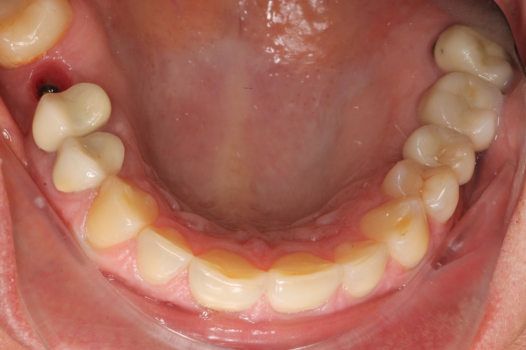Установка имплантата
