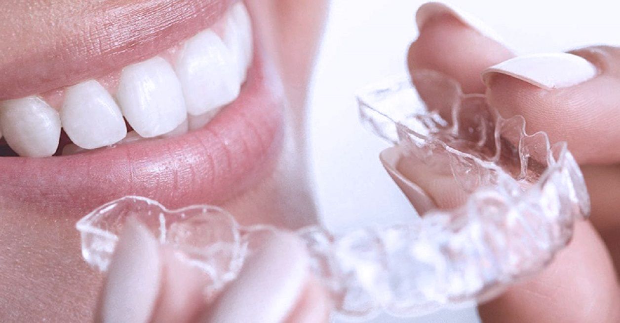 Элайнеры – выравнивание зубов без брекетов