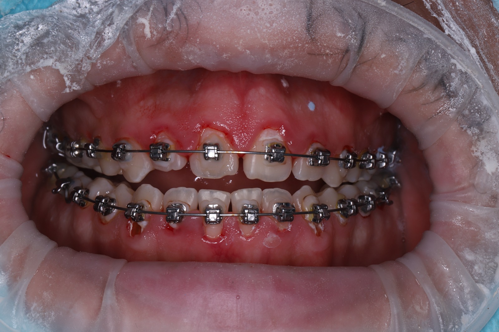 Лечение гингивита