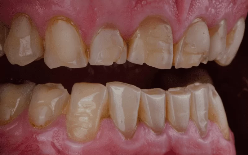 Стираются зубы: почему и что делать?