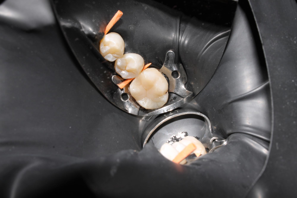 Металлокерамика: показания к применению и меры предосторожности