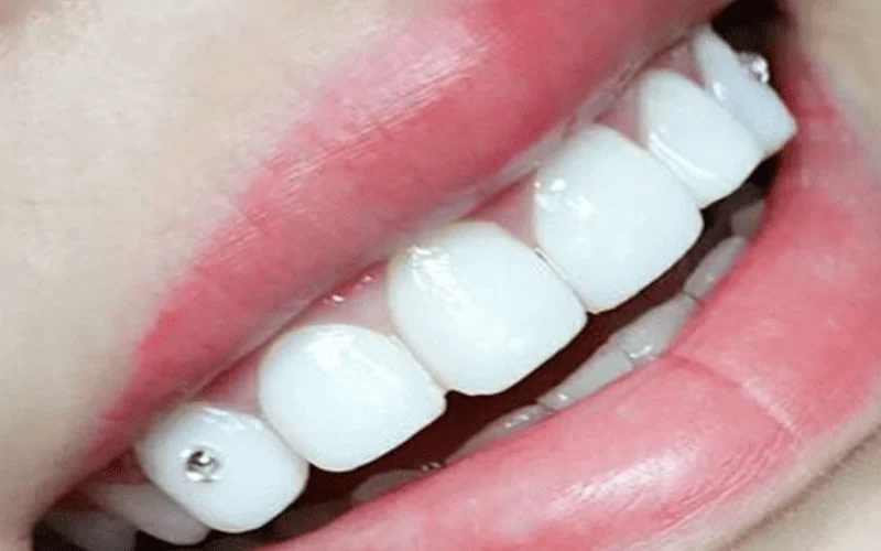 Что такое скайсы и сколько они держатся на зубах?