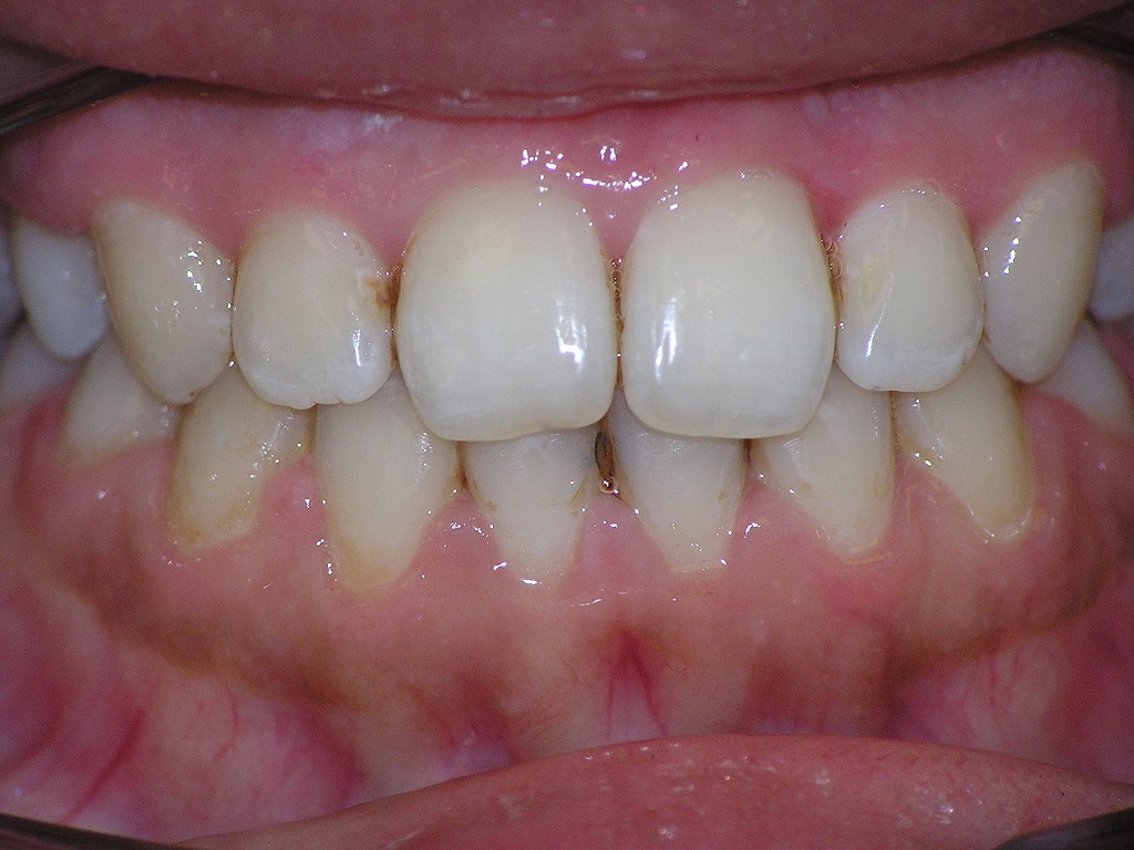 Исправление прикуса