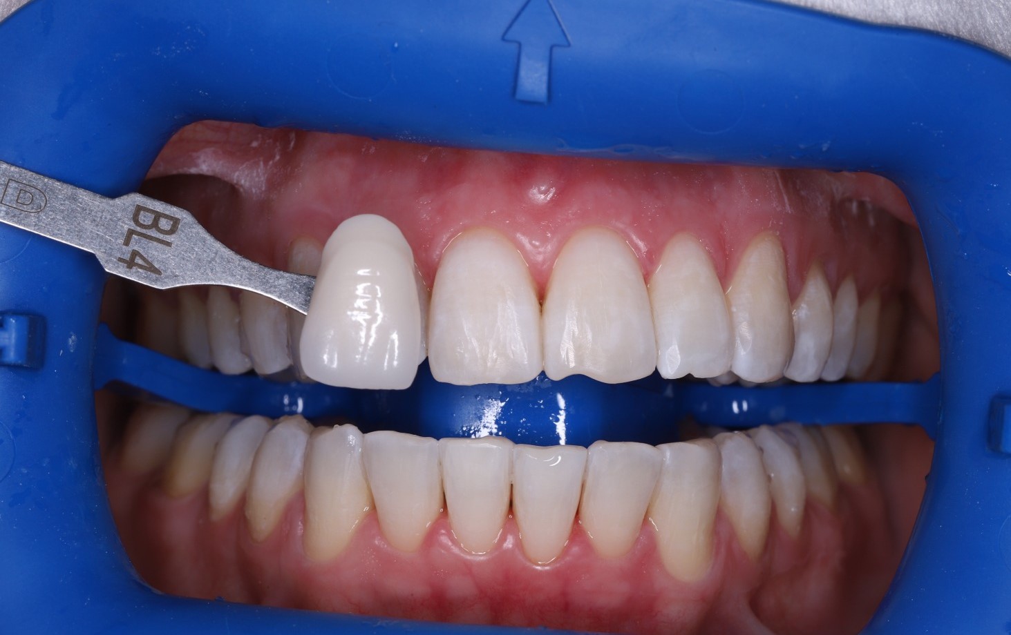 Отбеливание Zoom 4