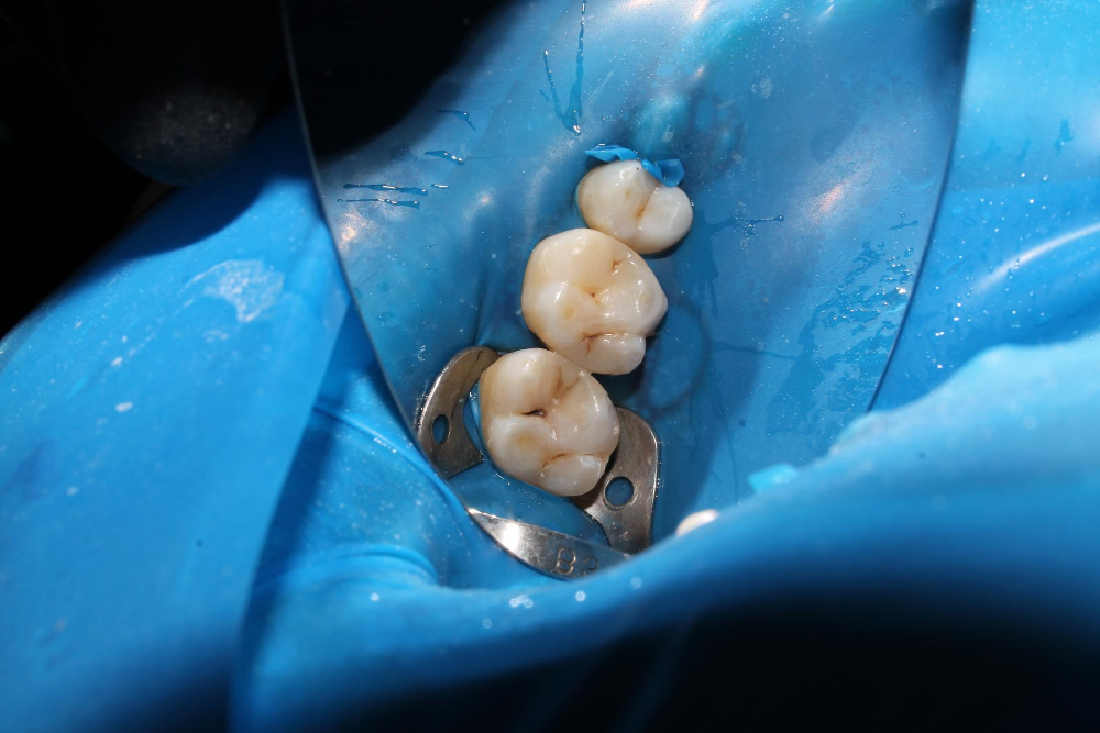 Пришеечный кариес: всё, что вам нужно знать