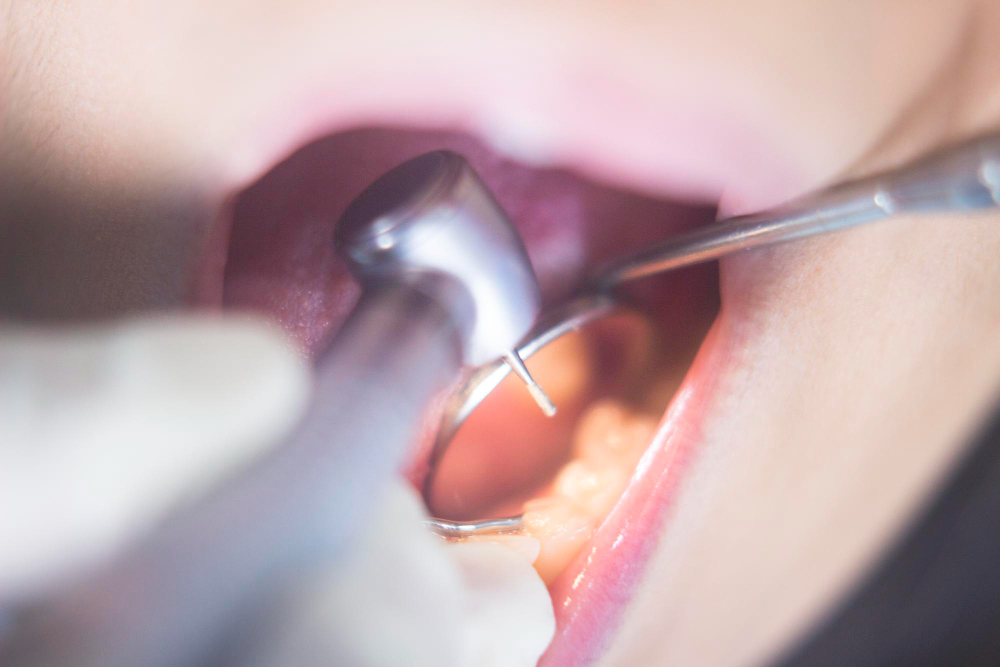 Пломбирование канала методом латеральной конденсации