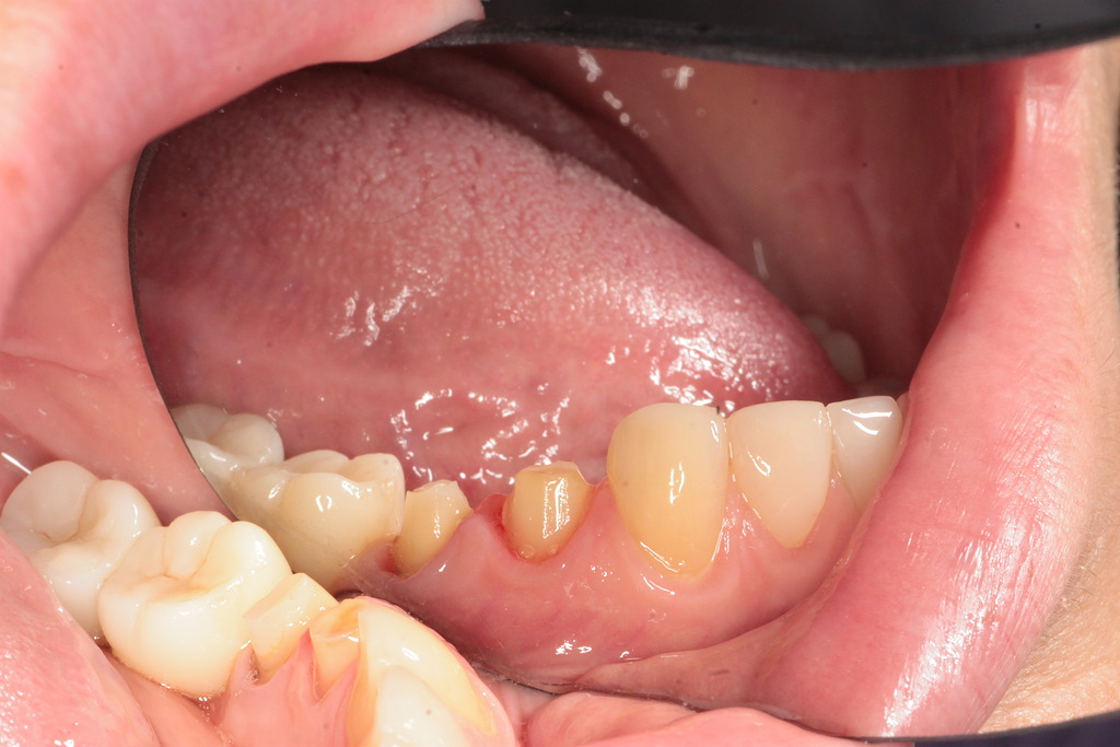 Коронки из диоксид циркония