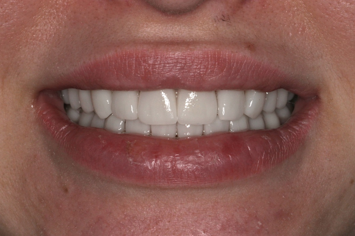 Керамические виниры