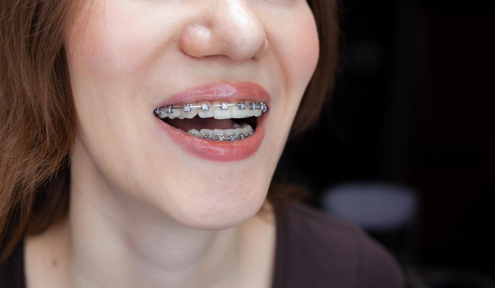 Как исправить зубы без брекетов?