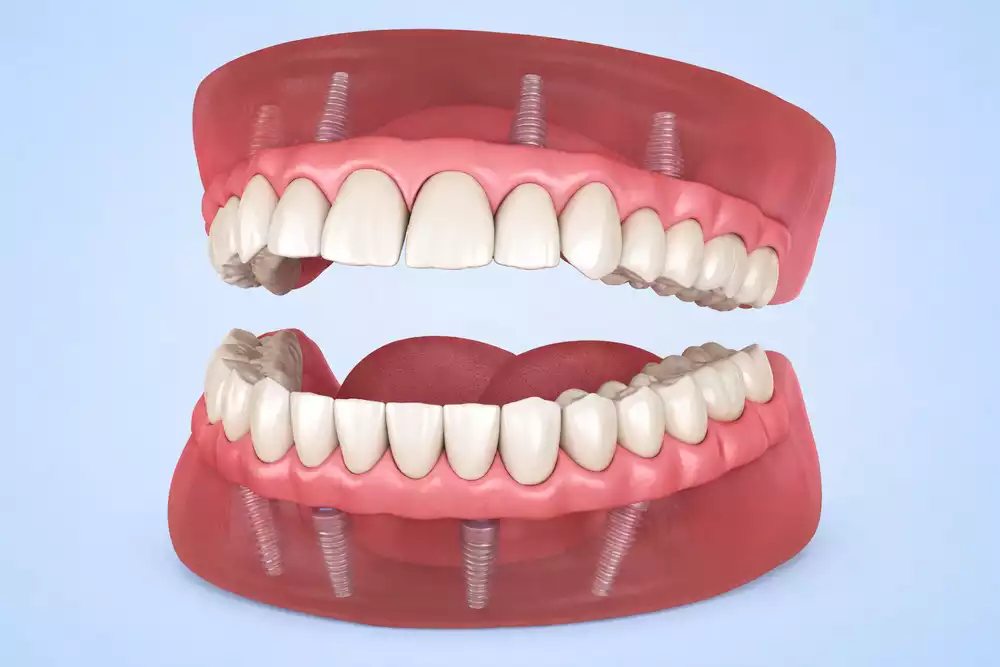 Замена всех зубов на импланты: методы, этапы и варианты протезирования