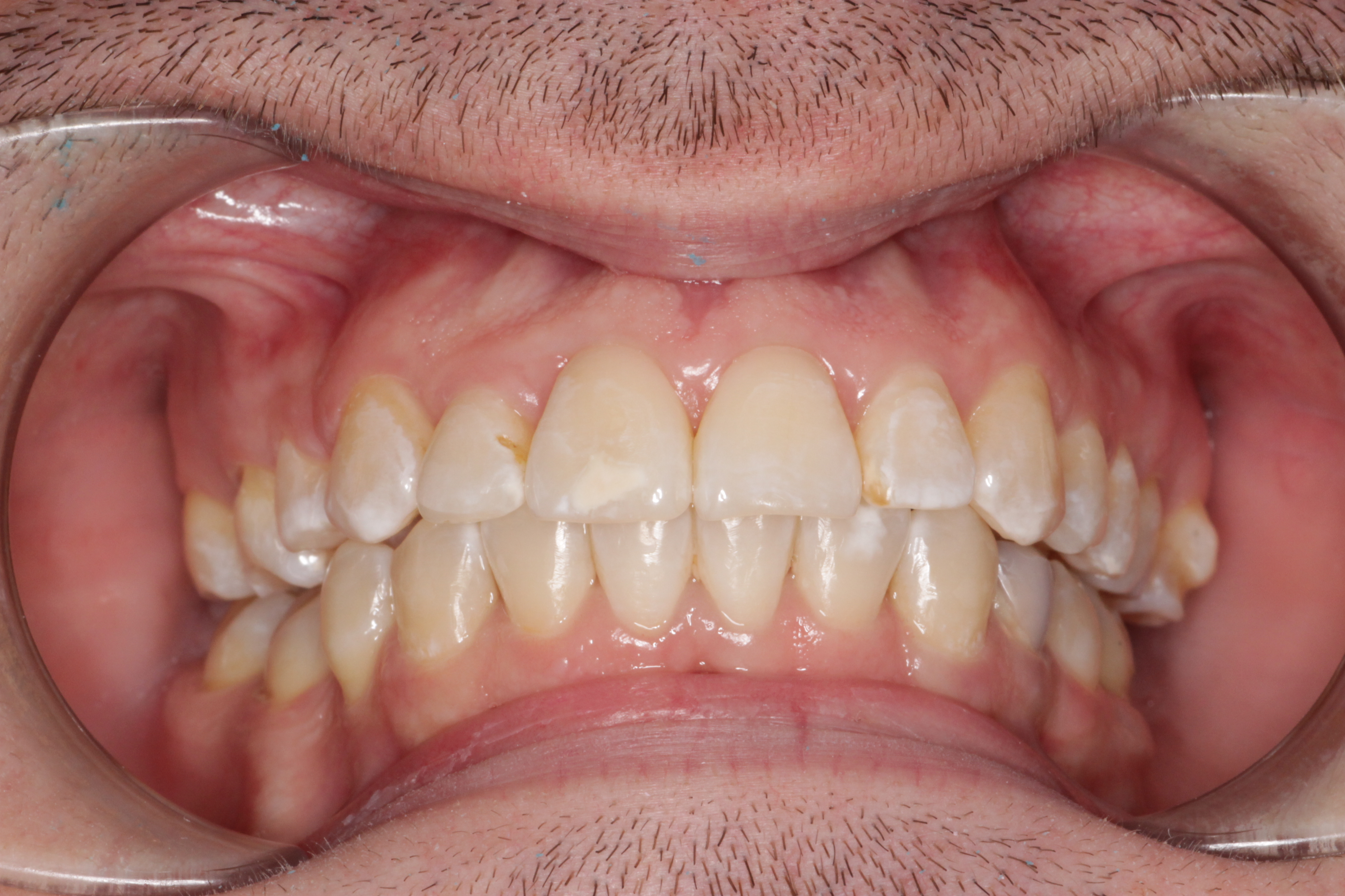 Исправление прикуса брекетами