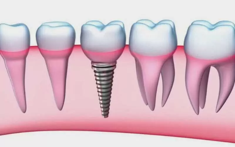 Имплантация без синус-лифтинга