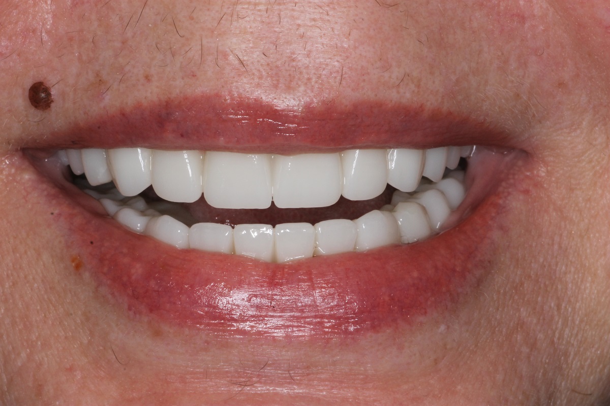 Восстановление верхней и нижней челюсти по системе All-on-6