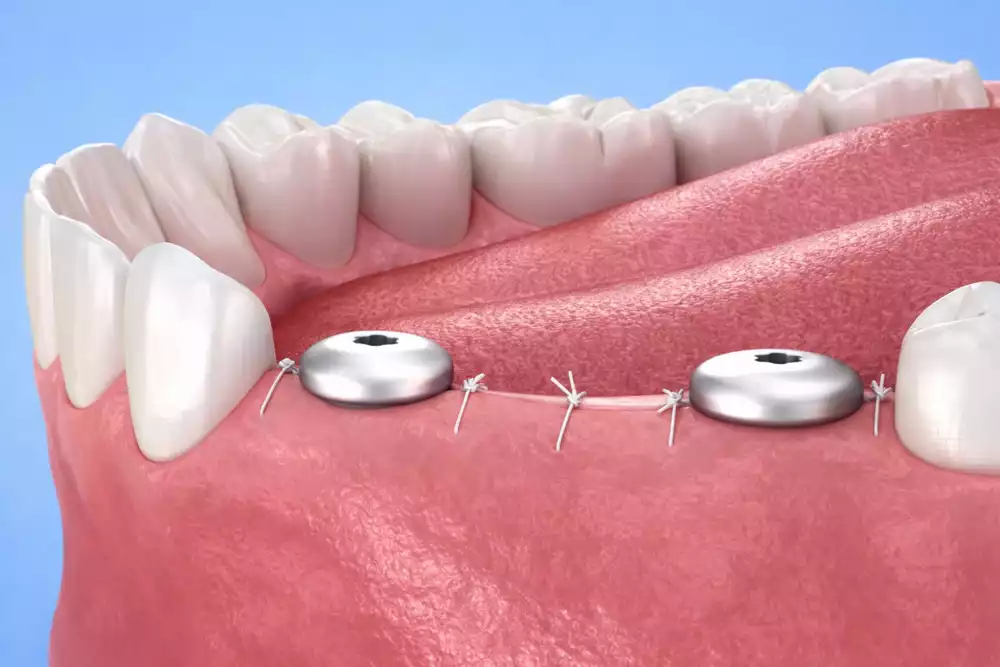 Формирователь десны при имплантации: зачем нужен и как проходит установка