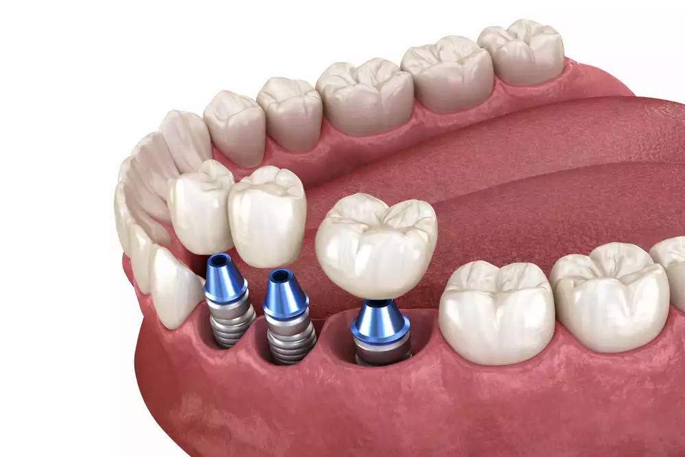 Сколько служат зубные импланты: реальный срок службы и гарантии