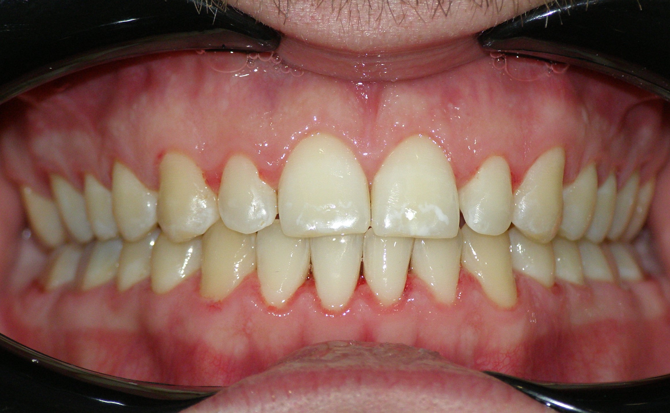 Исправление прикуса брекетами