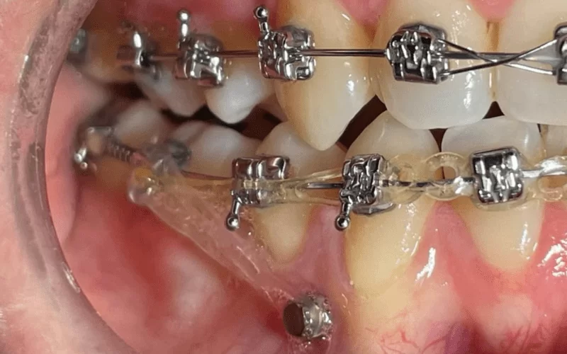 Микроимпланты в ортодонтии: что это и зачем?