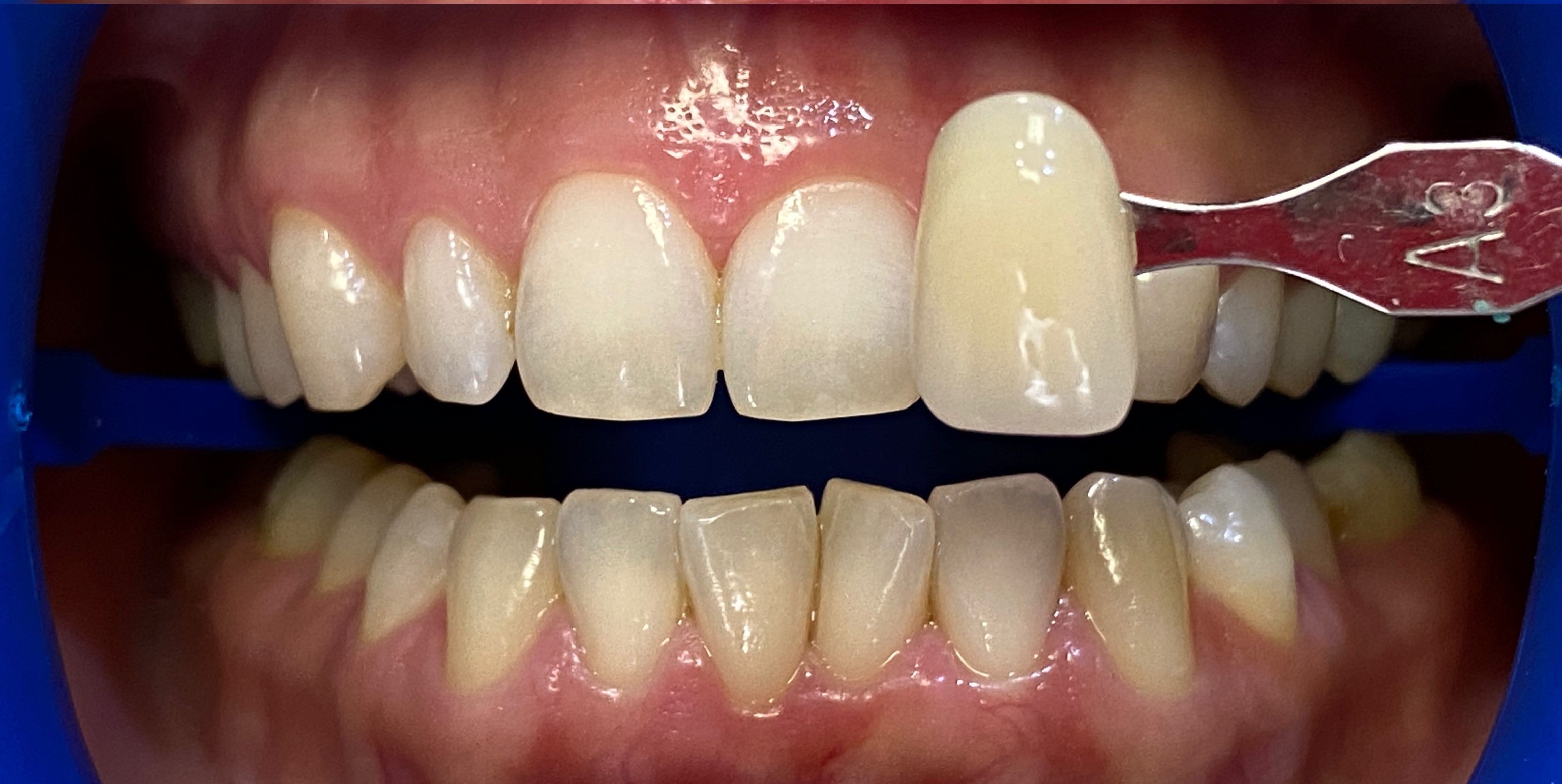 Отбеливание