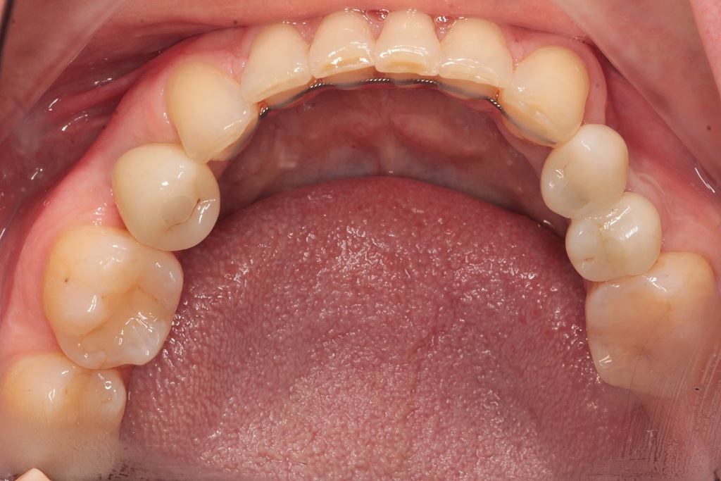 Имплантация зуба в зоне улыбки