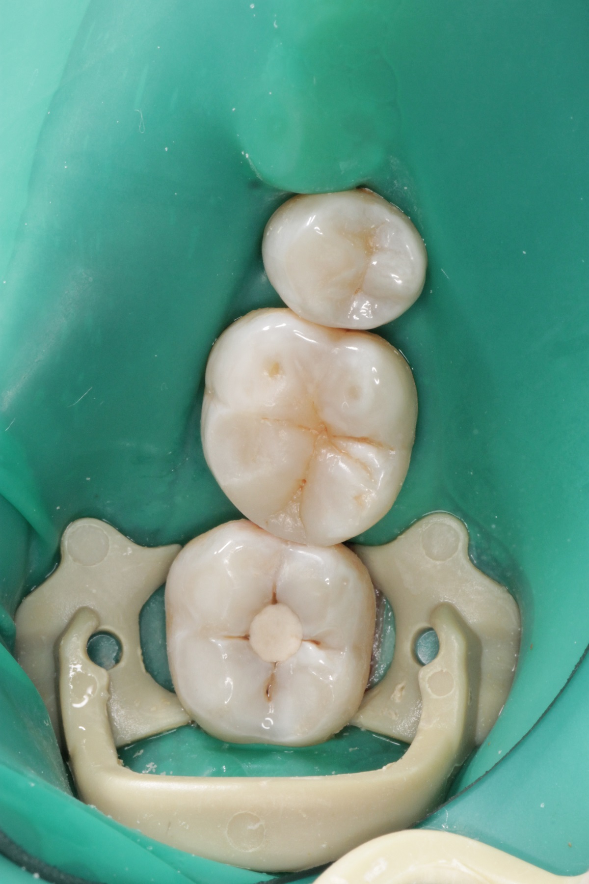 Лечение кариеса