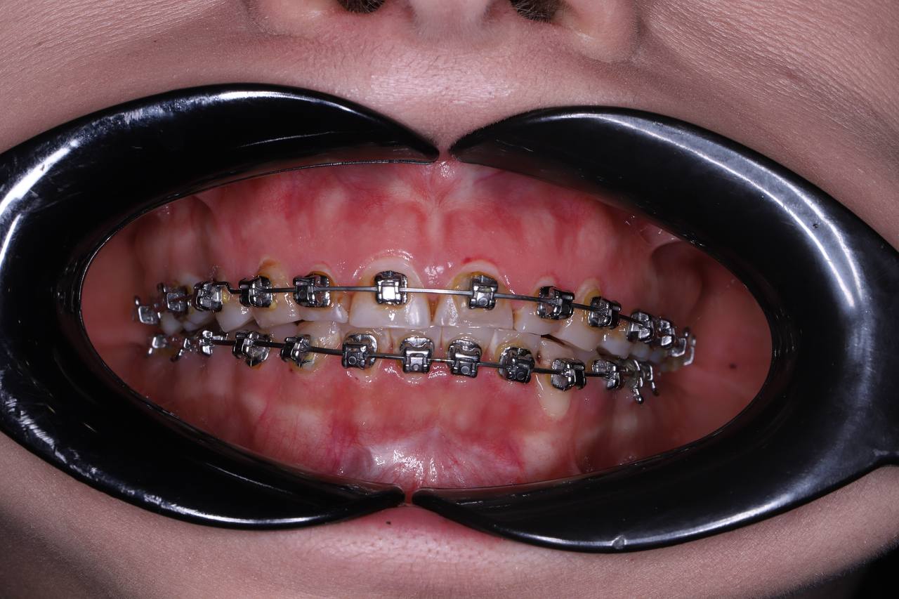 Удлинение клинической коронки зуба