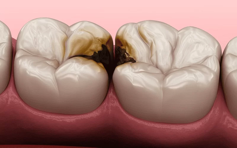 Лечение кариеса между жевательными или передними зубами