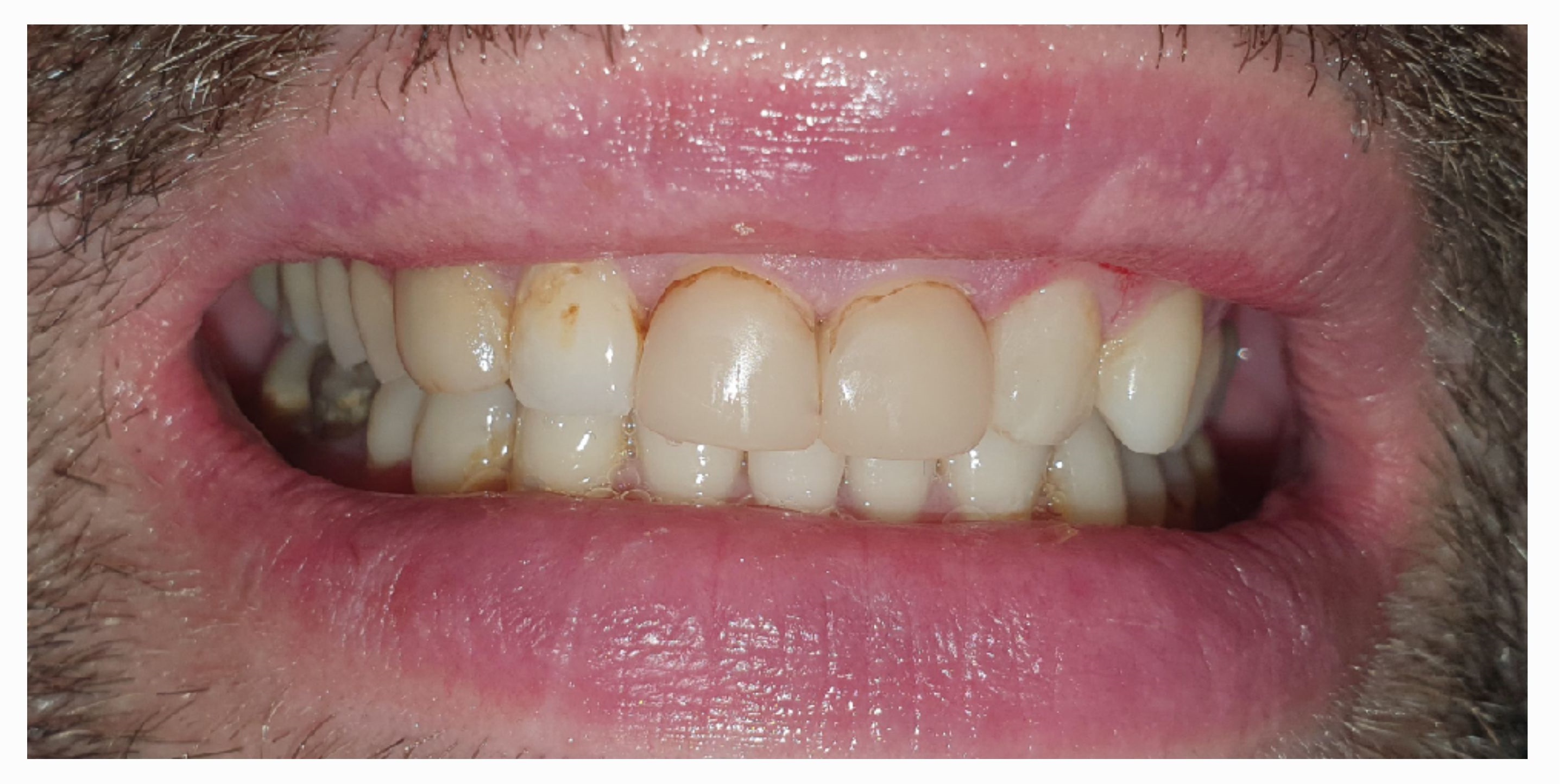 Композитные виниры