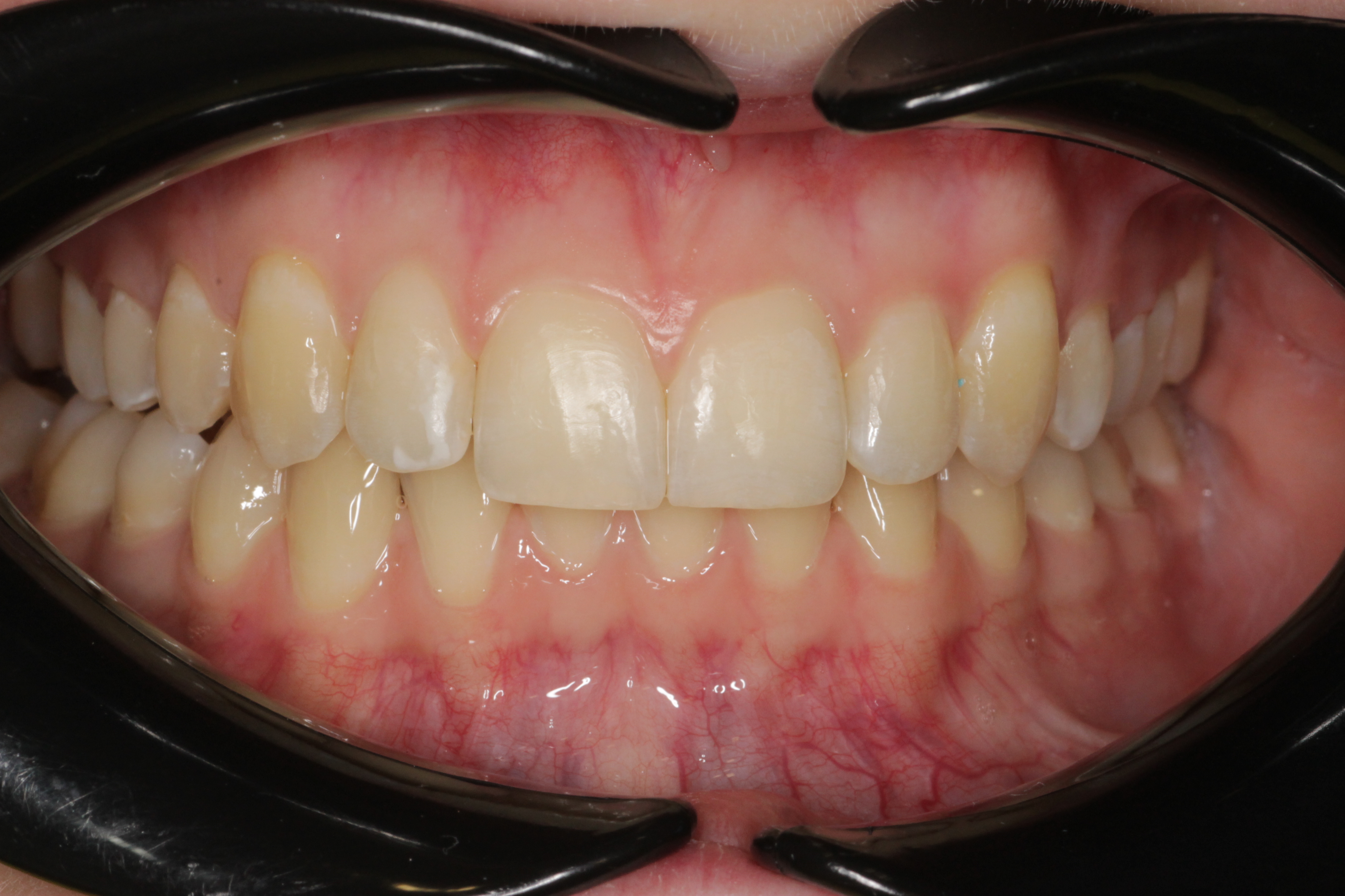 Исправление прикуса брекетами