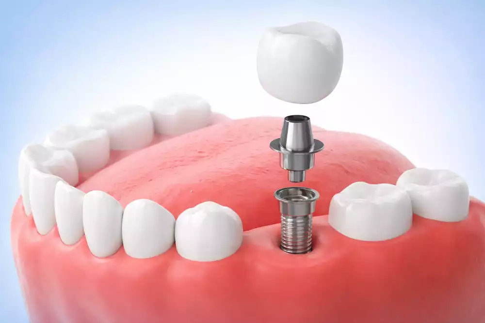 Зубные протезы на имплантах — виды конструкций, преимущества и сроки приживления