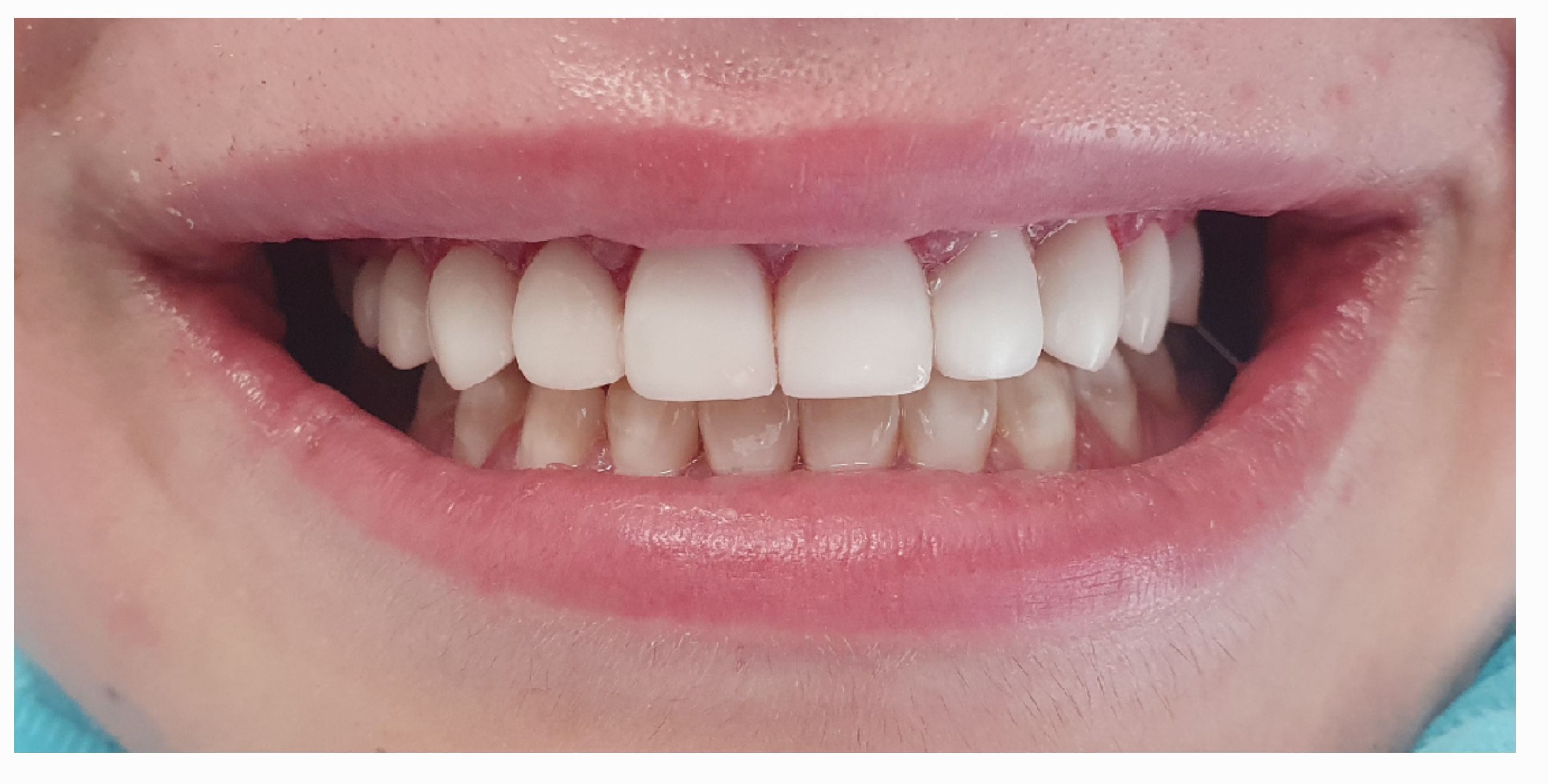 Композитные виниры